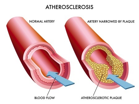 Atherosclerosis