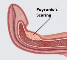 Peyronies